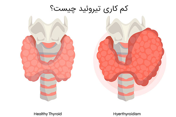 کم کاری تیروئید چیست؟