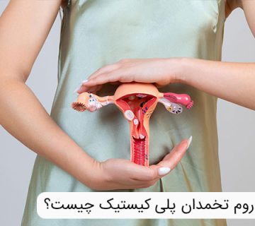 سندروم تخمدان پلی کیستیک چیست؟