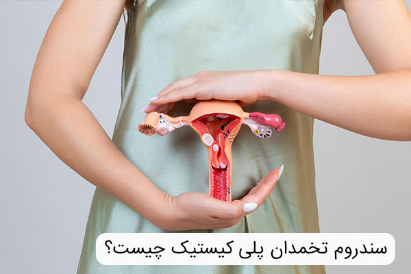 سندروم تخمدان پلی کیستیک چیست؟